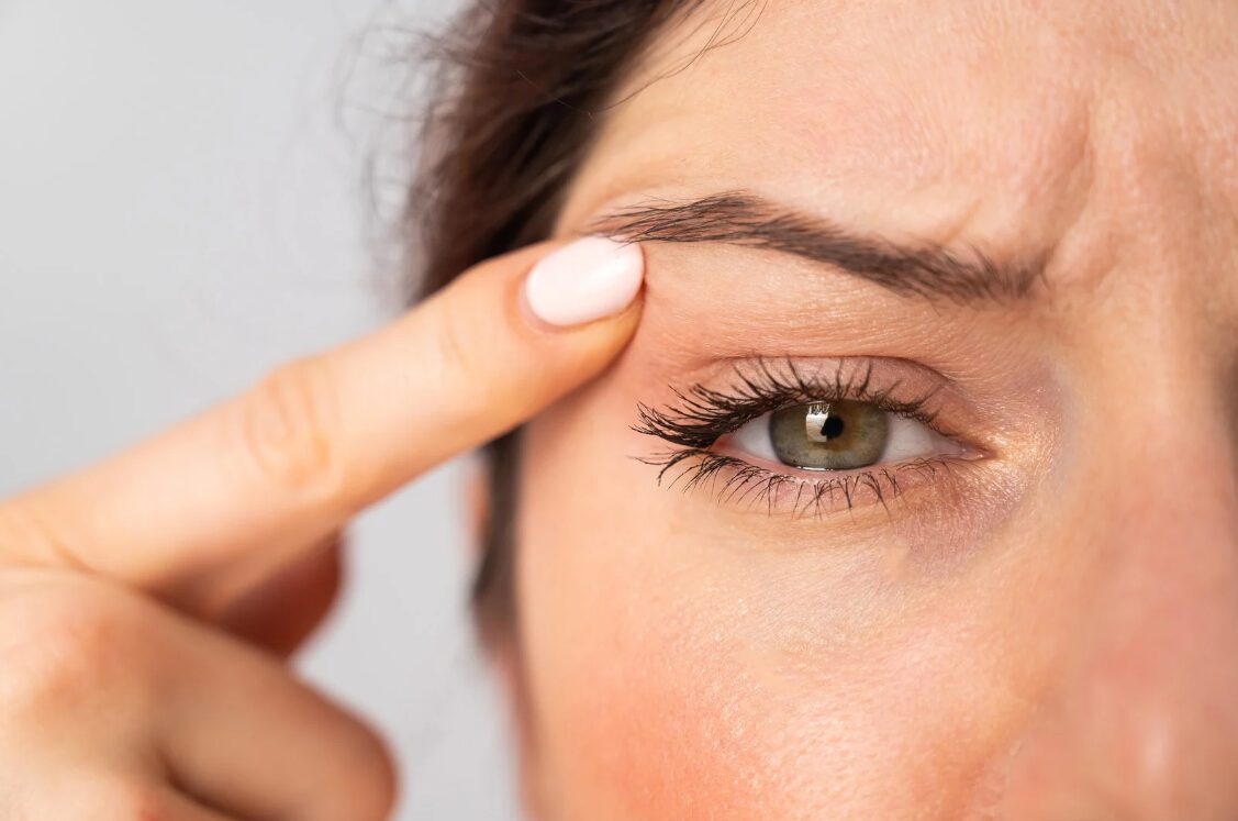 Oberlidstraffung Vorher Nachher