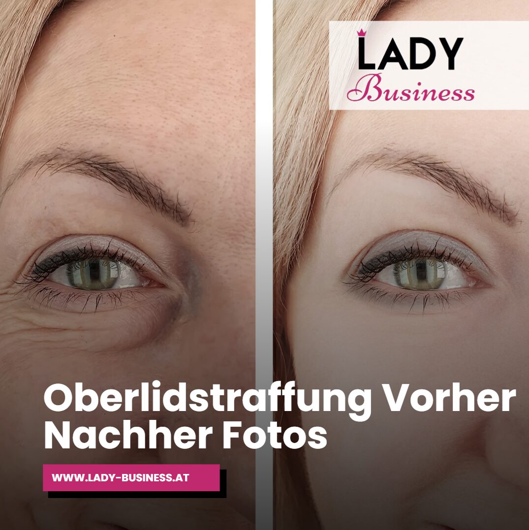 oberlidstraffung vorher nachher fotos oberlidstraffung vorher nachher fotos