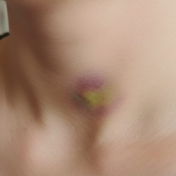 Wie lange dauert es bis ein Knutschfleck weg ist Warum Geduld entscheidend ist